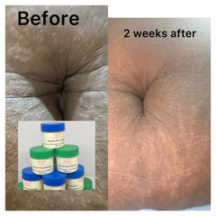 Stretch Mark Powder Removal, No more Stretch mark, Stretch mark be gone in two (2) weeks